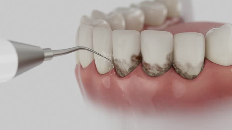 Trusted Tooth Extraction service in Bellevue, WA - Dentist Open Now